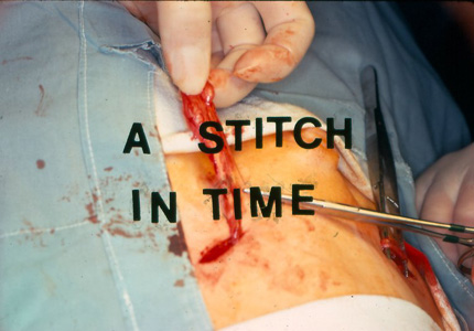 A stitch in time