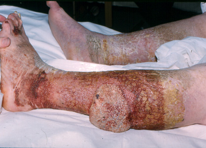 severe skin conditions